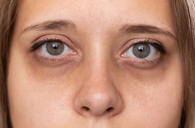 dark-circles