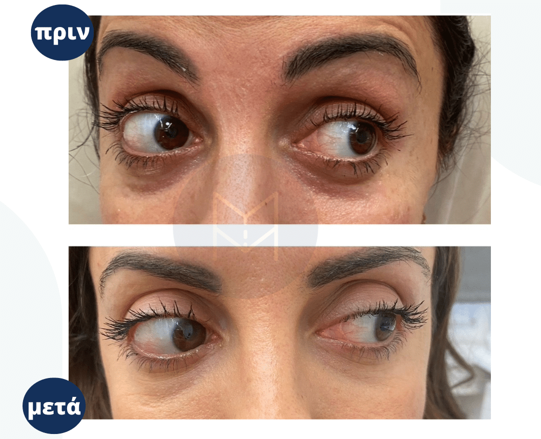 mauroi kykloi prin-meta