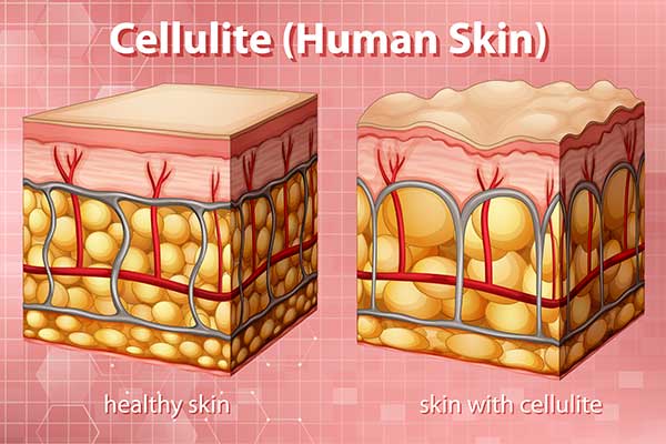 Κυτταρίτιδα: Είναι γυναικεία αποκλειστικότητα;