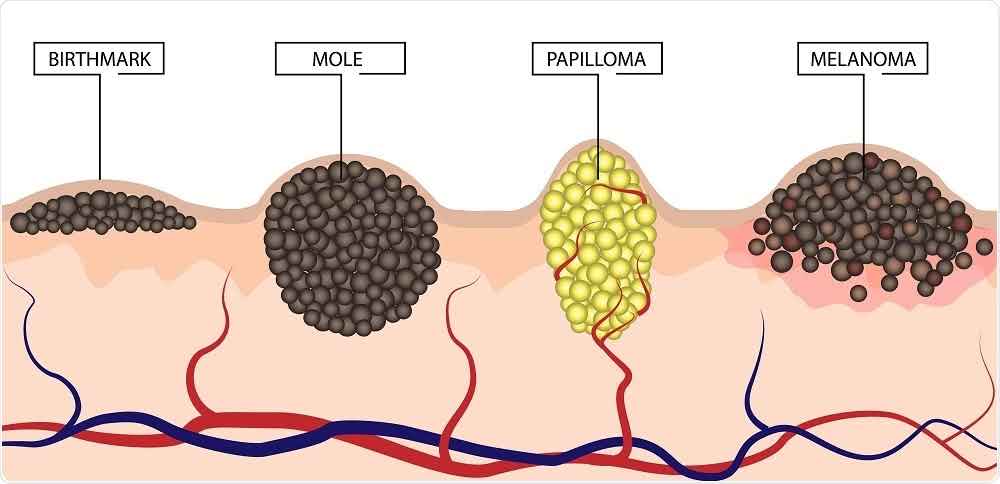 moles-surgery