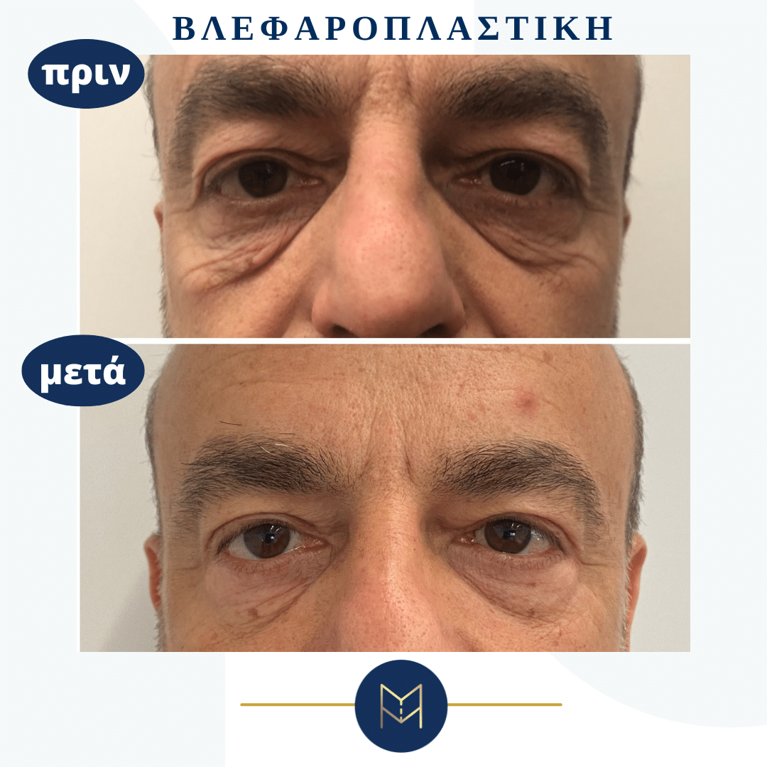 blepharoplastiki-andres