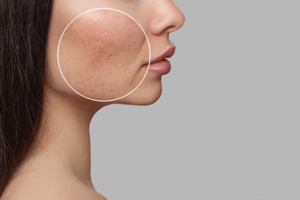 Τι είναι το Fractional laser CΟ2 και σε ποιες περιπτώσεις το χρησιμοποιούμε;