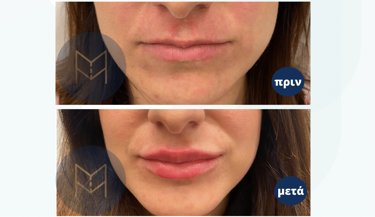 lip fillers hyaluronic