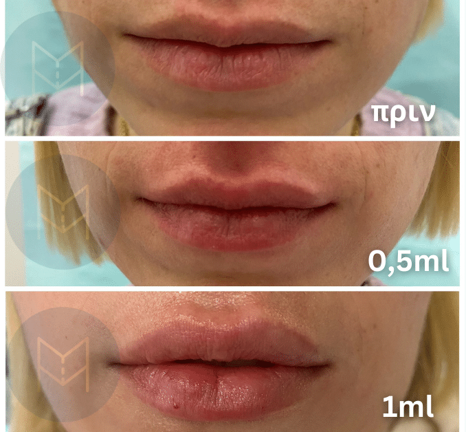 hyalouronic-quantity