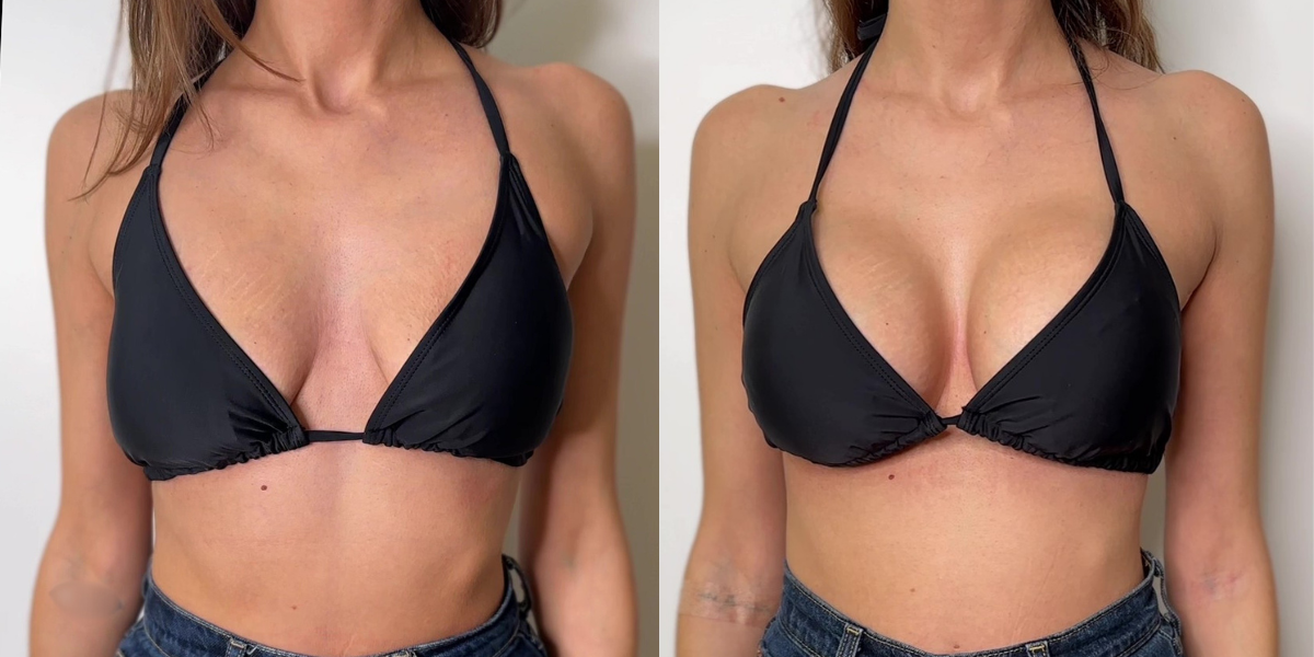 Αυξητική στήθους_case 1_image 1_1200x600