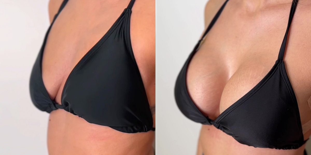 Αυξητική στήθους_case 1_image 2_1200x600