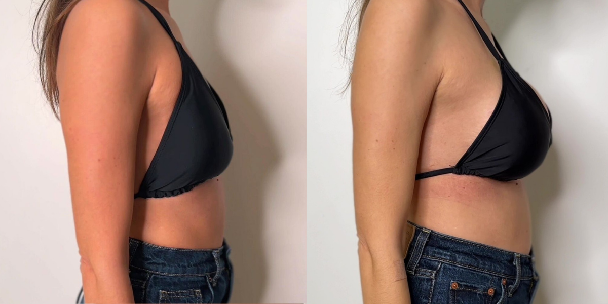 Αυξητική στήθους_case 1_image 3_1200x600