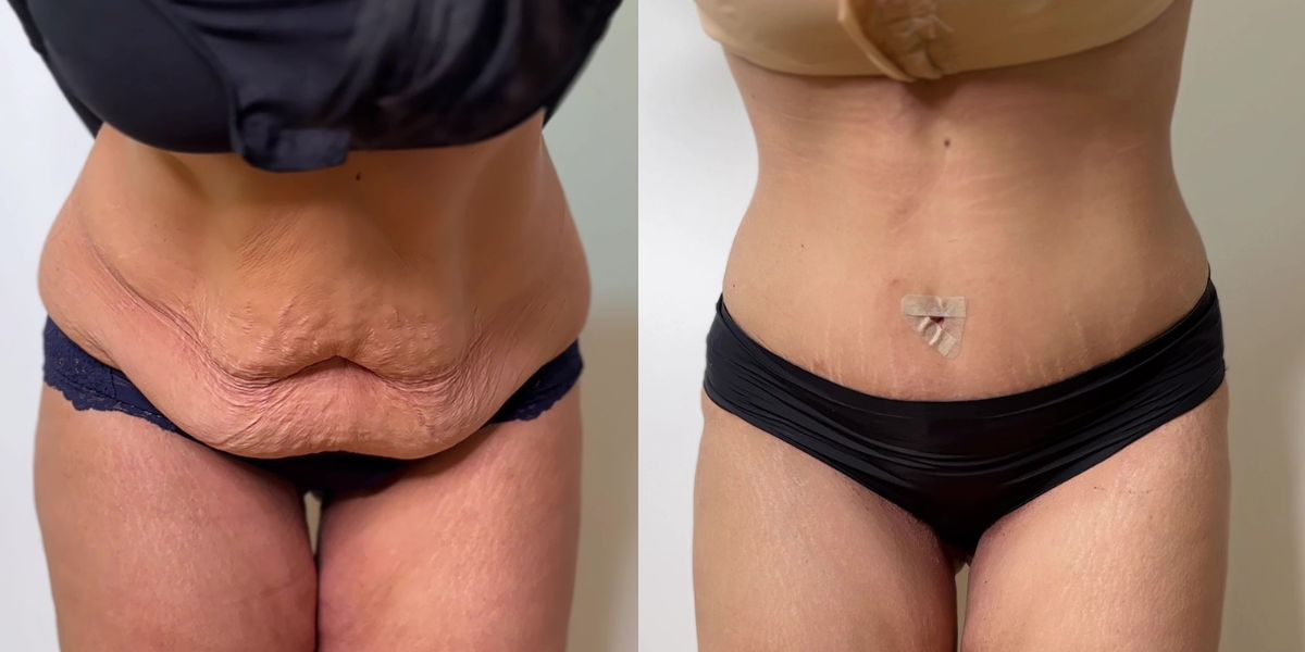 Κοιλιοπλαστική case 1_image 2