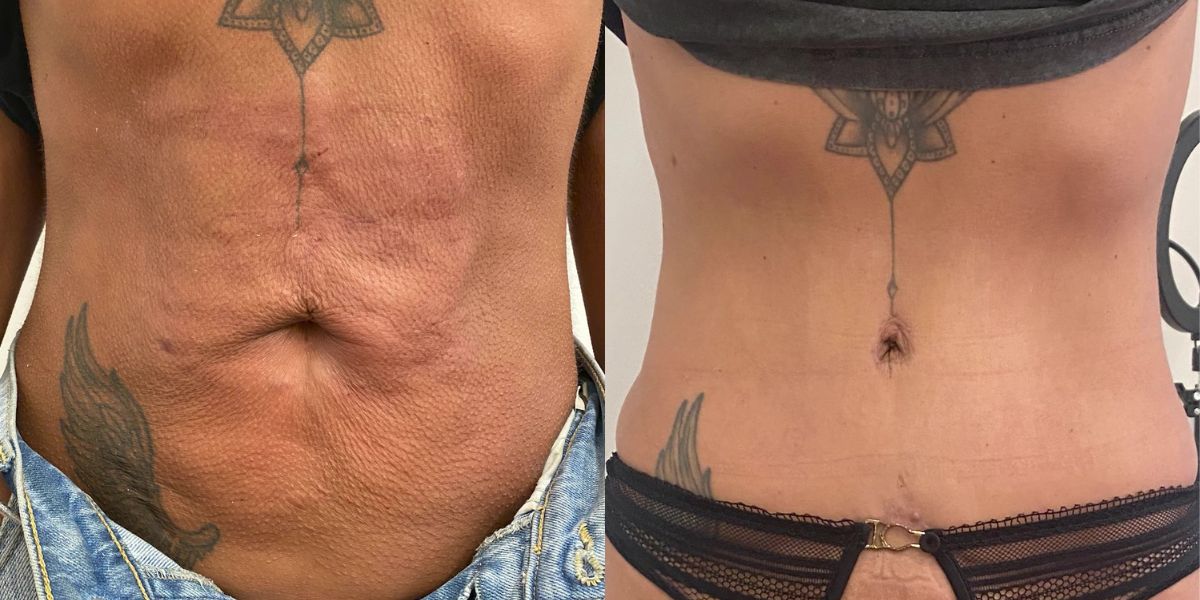 Κοιλιοπλαστική case 2_image 1