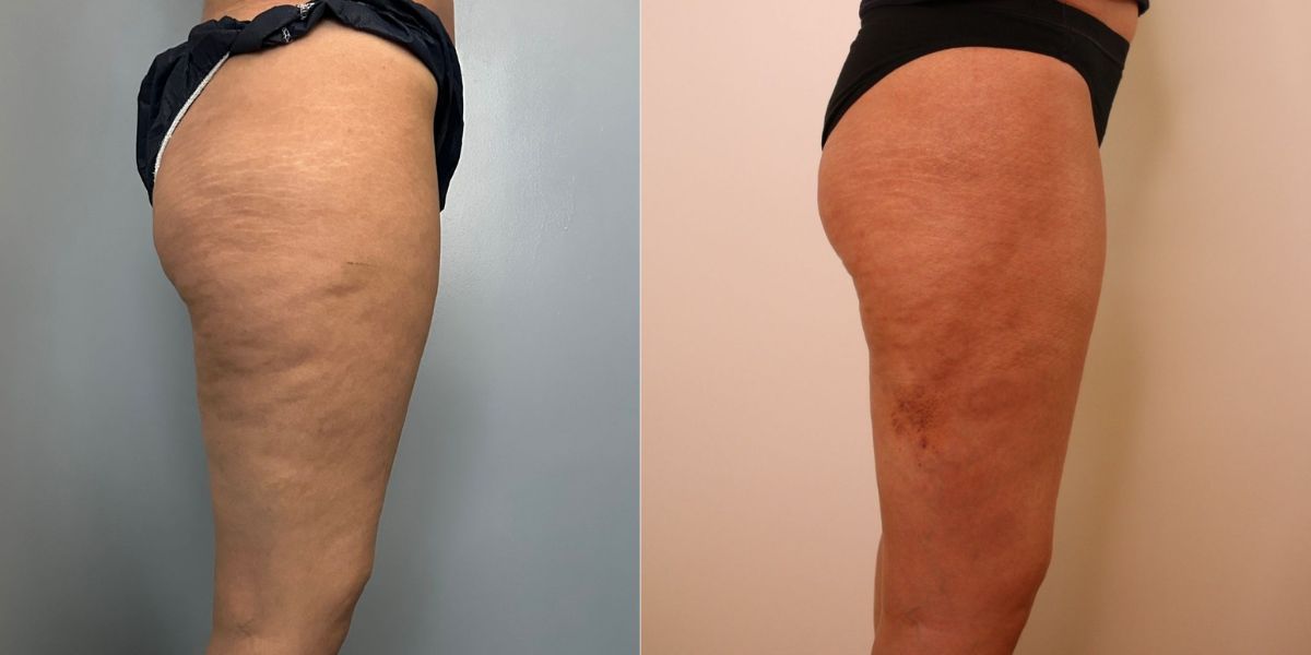 Λιποαναρρόφηση Vaser case 1_image 2