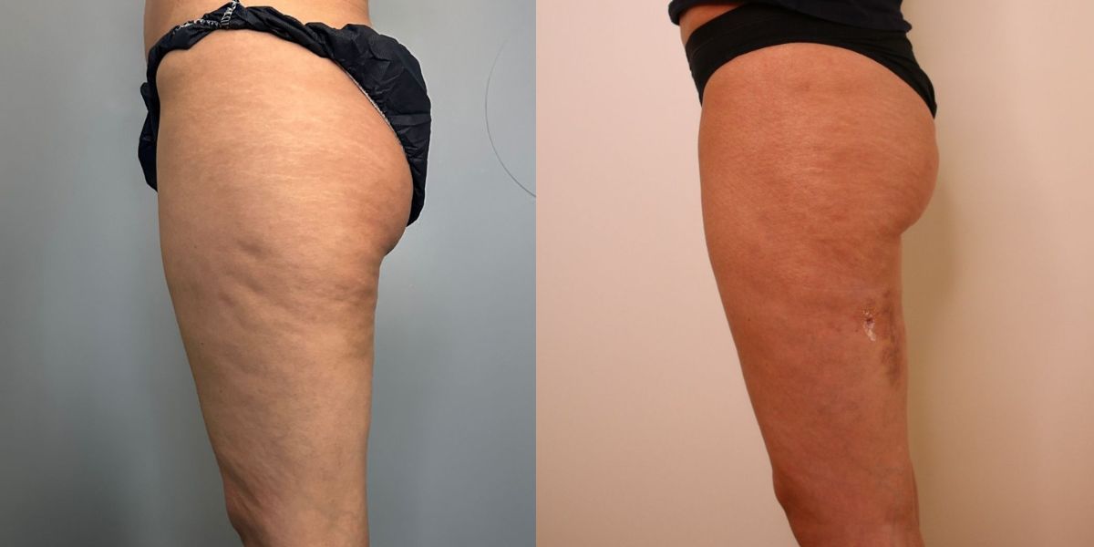 Λιποαναρρόφηση Vaser case 1_image 3