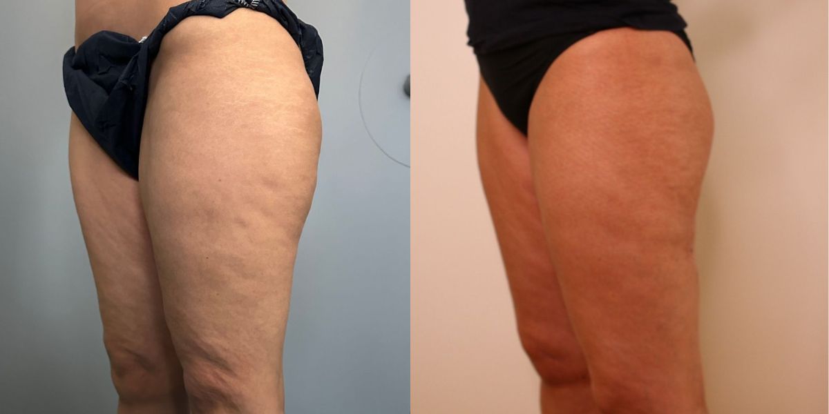 Λιποαναρρόφηση Vaser case 1_image 4