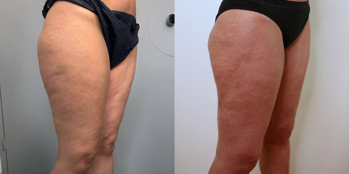 Λιποαναρρόφηση Vaser case 1_image 5