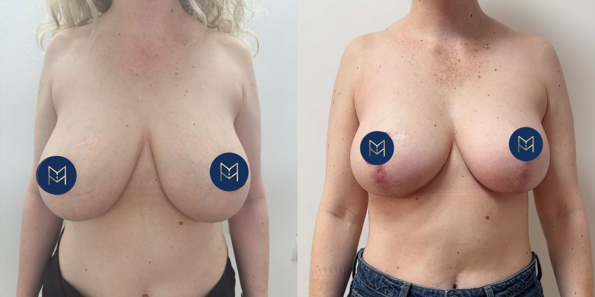 Μειωτική στήθους case 1_image 1 (χωρίς στηθόδεσμό)