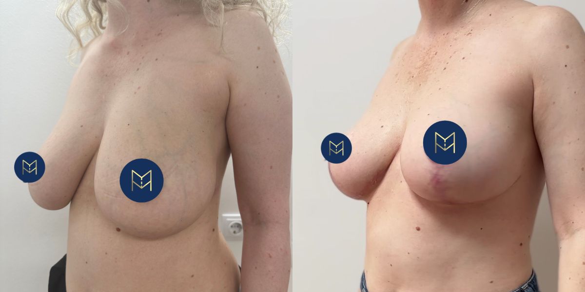 Μειωτική στήθους case 1_image 2 (χωρίς στηθόδεσμό)