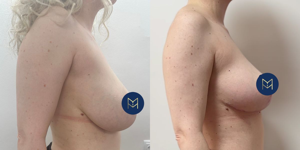 Μειωτική στήθους case 1_image 4 (χωρίς στηθόδεσμό)