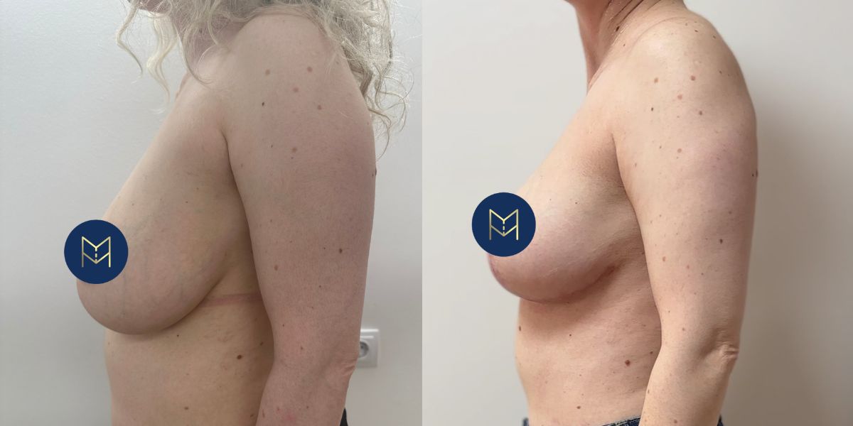 Μειωτική στήθους case 1_image 5 (χωρίς στηθόδεσμό)