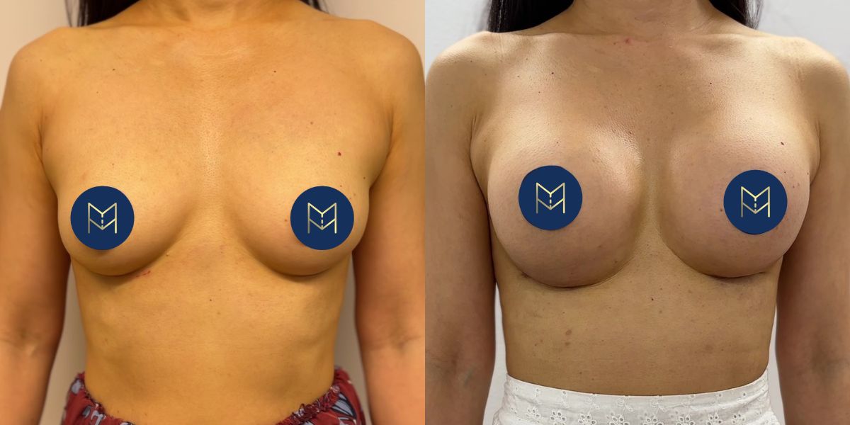 Αυξητική στήθους_case 2_image 1