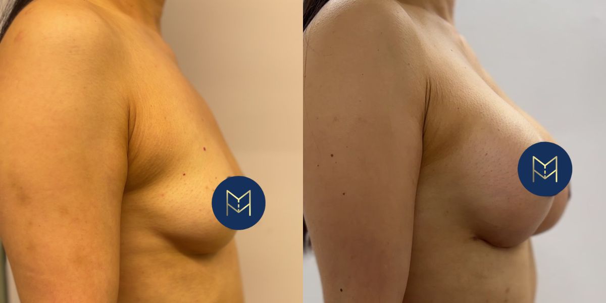 Αυξητική στήθους_case 2_image 2