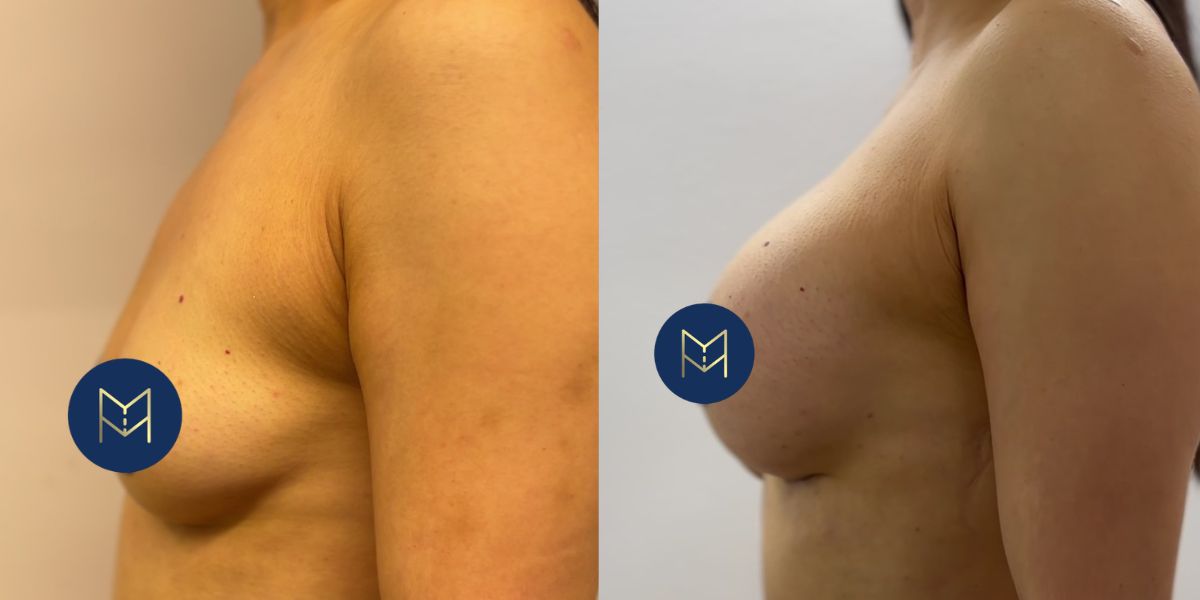 Αυξητική στήθους_case 2_image 3