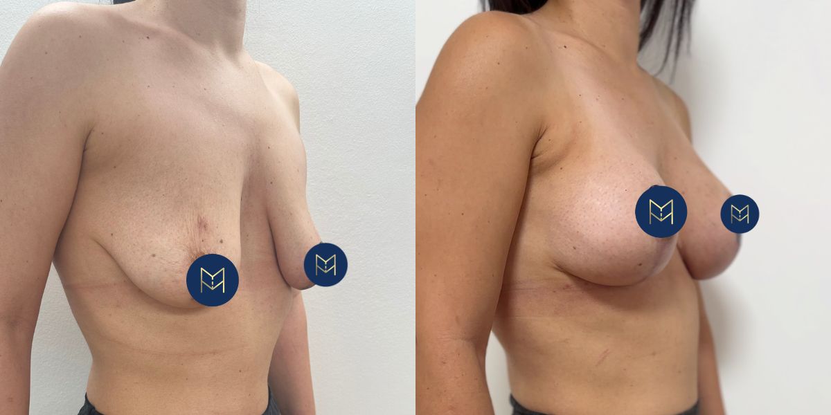 Αυξητική στήθους_case 3_image 2