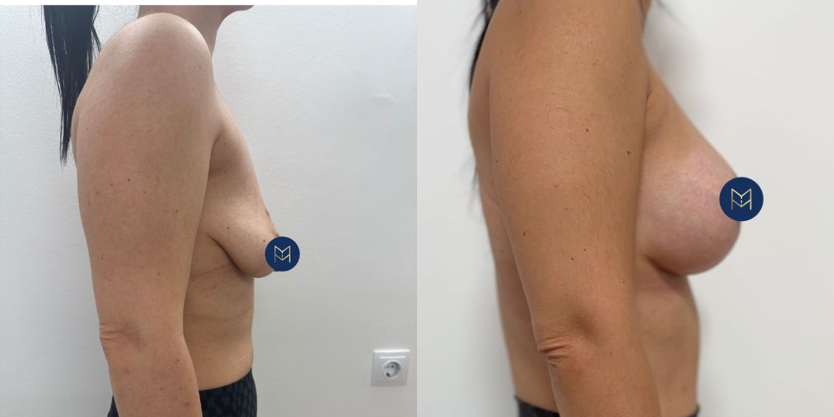 Αυξητική στήθους_case 3_image 3