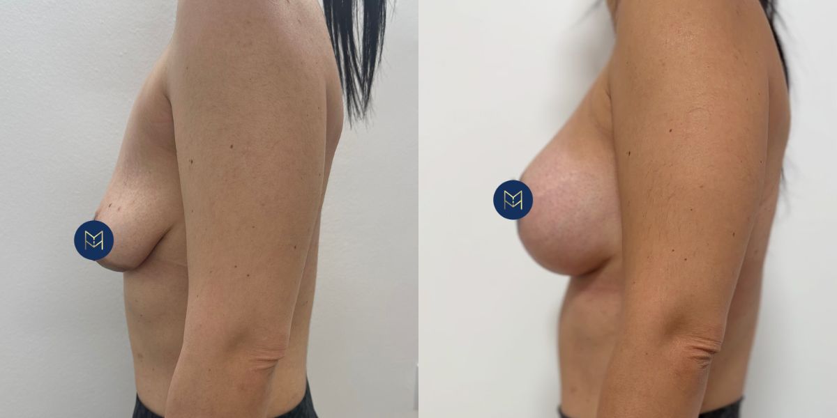 Αυξητική στήθους_case 3_image 4