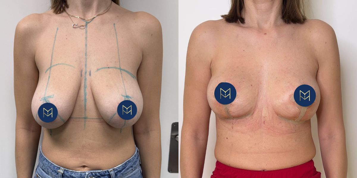 Αυξητική στήθους_case 4_image 1