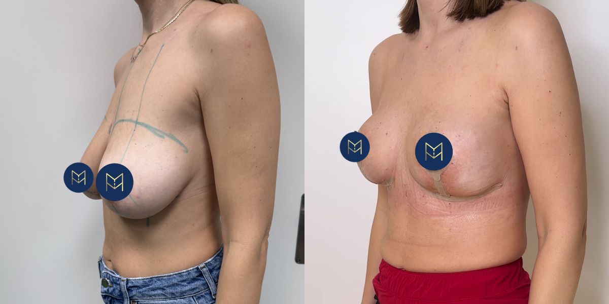 Αυξητική στήθους_case 4_image 2