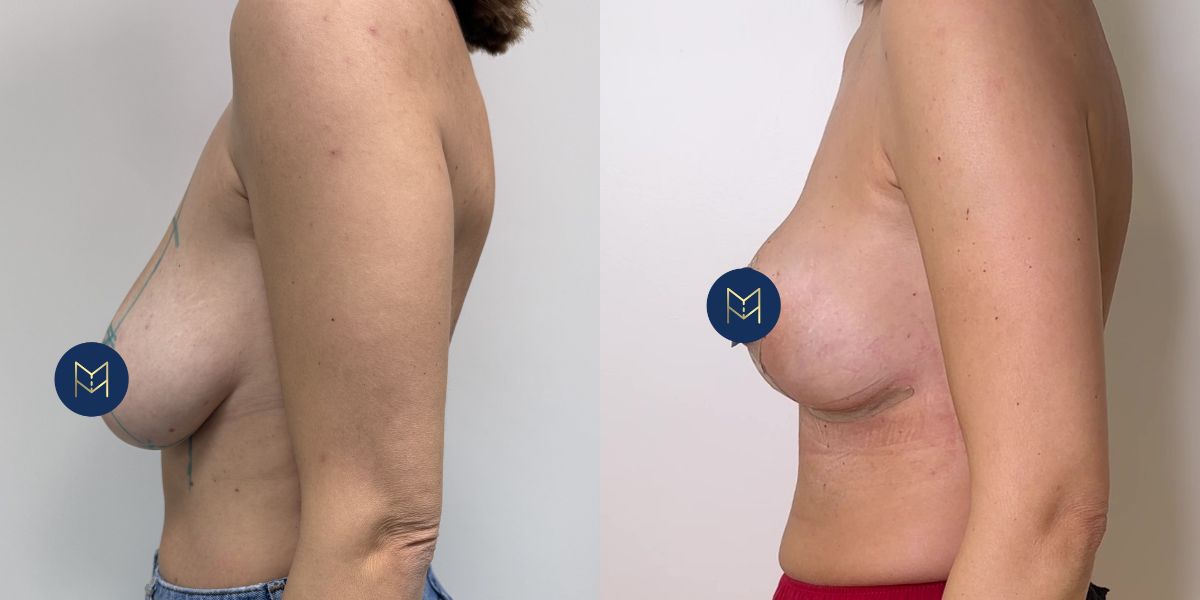 Αυξητική στήθους_case 4_image 3