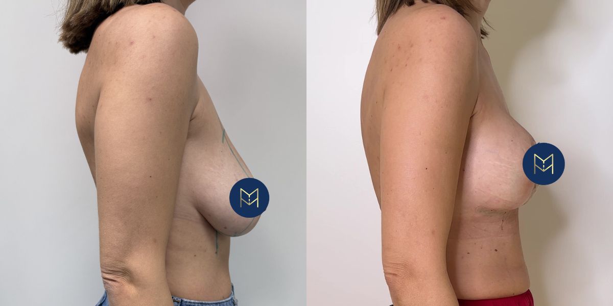 Αυξητική στήθους_case 4_image 4