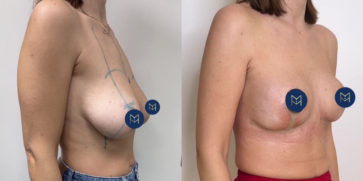 Αυξητική στήθους_case 4_image 5