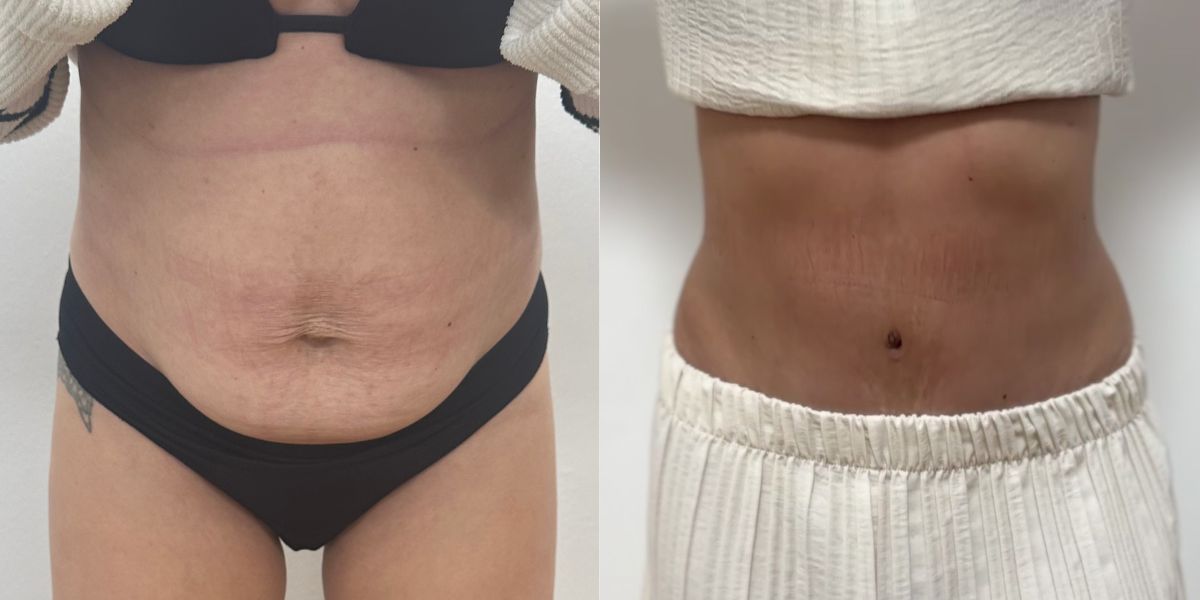 Κοιλιοπλαστική case 3_image 1