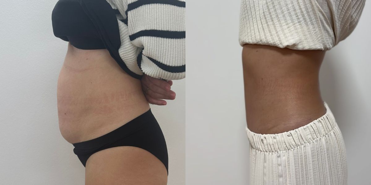 Κοιλιοπλαστική case 3_image 2