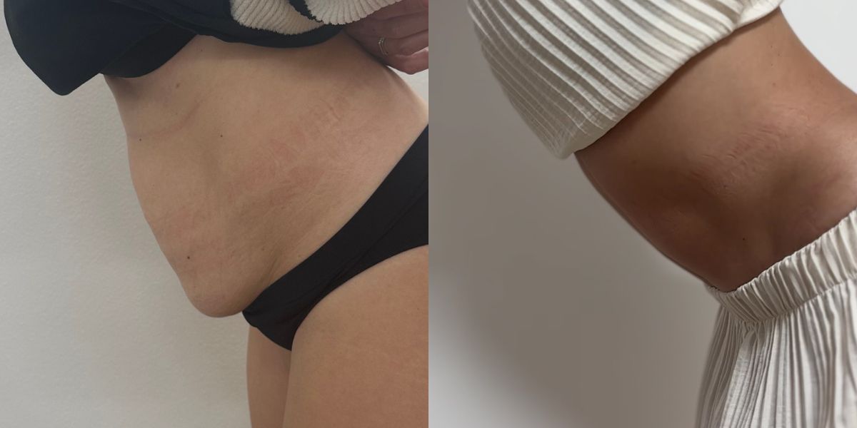 Κοιλιοπλαστική case 3_image 3