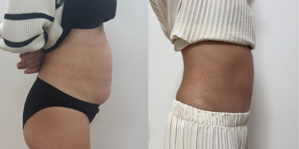 Κοιλιοπλαστική case 3_image 4