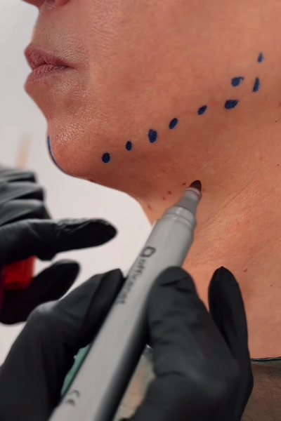 Margarita Moustaki_facelift_surgery design