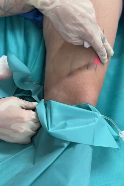 Margarita Moustaki_laser lift_application