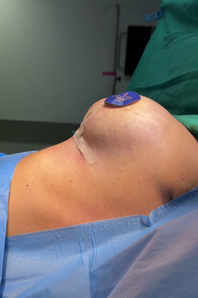 Margarita Moustaki_ανόρθωση στήθος_τεχνικές ανόρθωσης στήθους