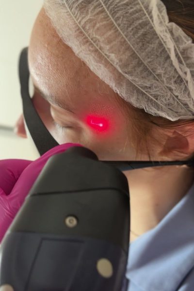 Margarita Moustaki_αφαίρεση ελιών_αφαίρεση με fractional CO2