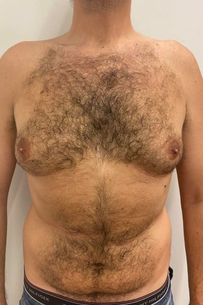 Margarita Moustaki_γυναικομαστία_από τι προκαλείται