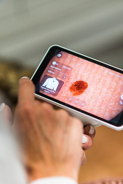 Margarita Moustaki_μελάνωμα_ποια σημάδια πρέπει να με κινητοποιήσουν