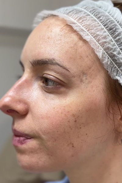 Margarita Moustaki_ουλές και χηλοειδή_πότε πρέπει να αντιμετωπίζονται