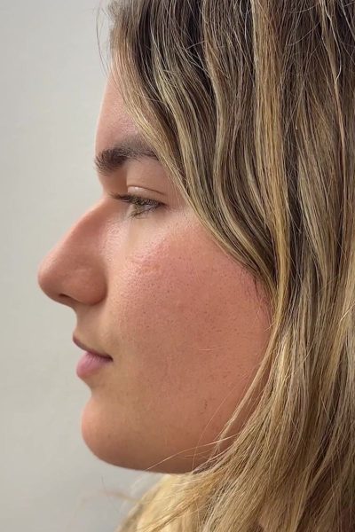 Margarita Moustaki_ρινοπλαστική_ειναι κατάλληλη για εμένα